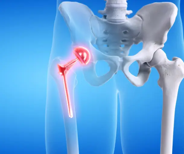 joint replacement surgery treatment